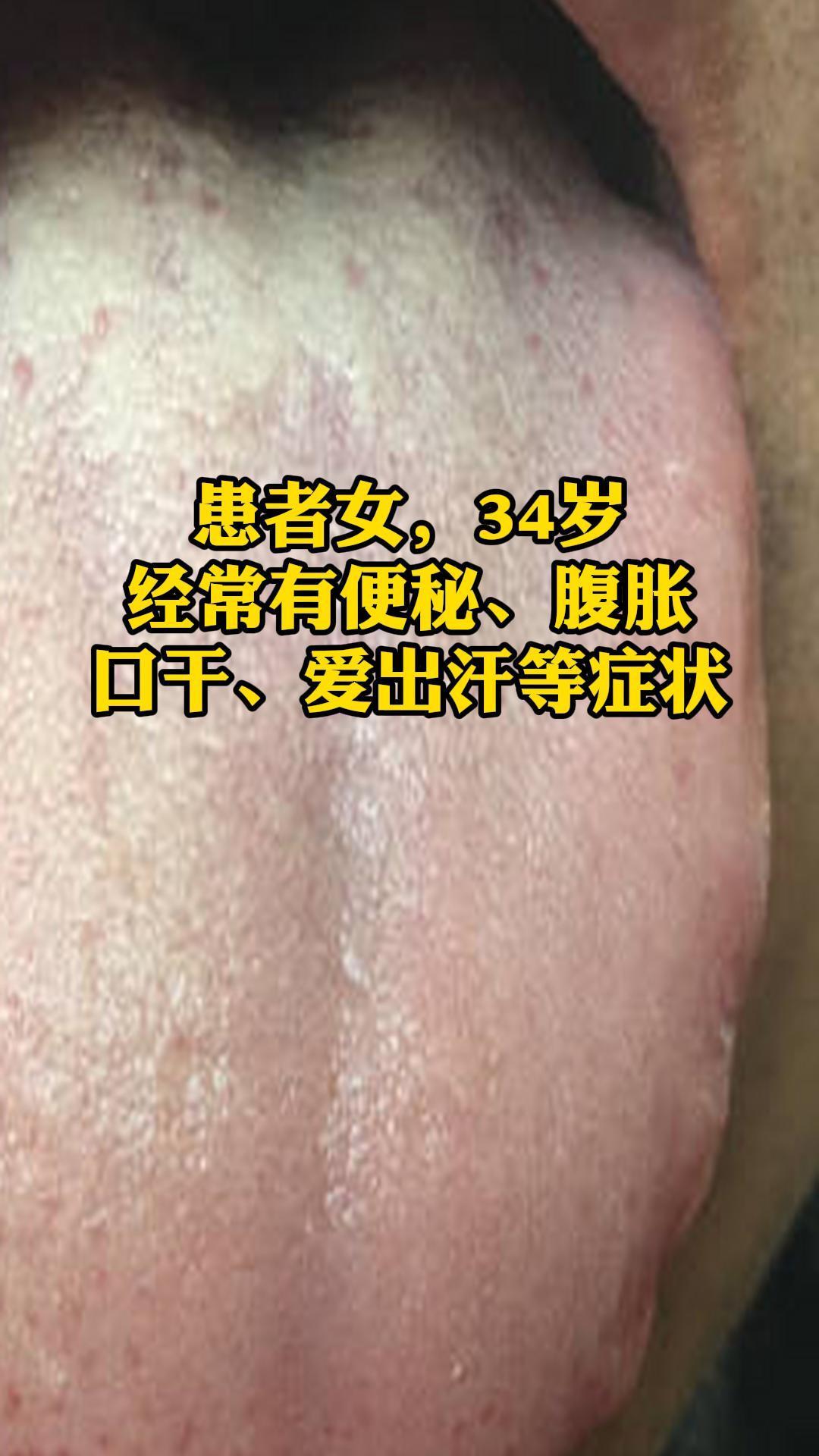 患者的舌苔表现为薄黄，通常表示体内有一定的热邪。舌边有齿痕，说明可能存在脾虚湿困的情况，导致舌体胖大，受牙齿压迫形成齿痕。舌尖略微发红，是心肺有热的体现，可能与心火亢盛或肺经有热有关。
患者常有便秘、腹胀，这通常与脾胃功能失调、肠道传导失常有关。口干则可能是热邪伤阴，导致津液不足。爱出汗的症状，从中医角度看，可能是气虚不固，或是热邪迫津外泄。
 
综合以上症状，患者可能属于脾胃湿热、心肺有热的体质。脾胃湿热会导致运化失健，气机不畅，从而出现腹胀、便秘等症状；湿热熏蒸，上犯口舌，则见口干、舌苔薄黄。心肺有热