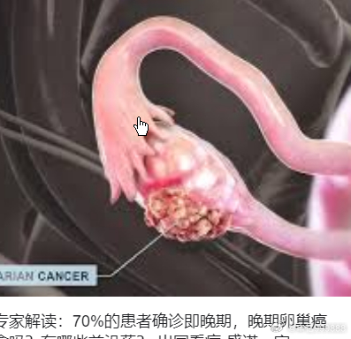70%卵巢癌确诊时已是晚期70%卵巢癌确诊时已是晚期刘颖医生警告说：“由于卵巢位