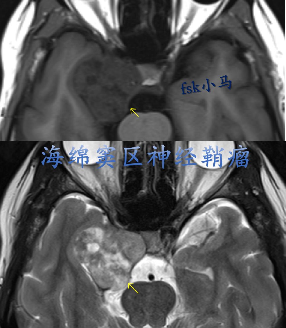 海绵窦区神经鞘瘤