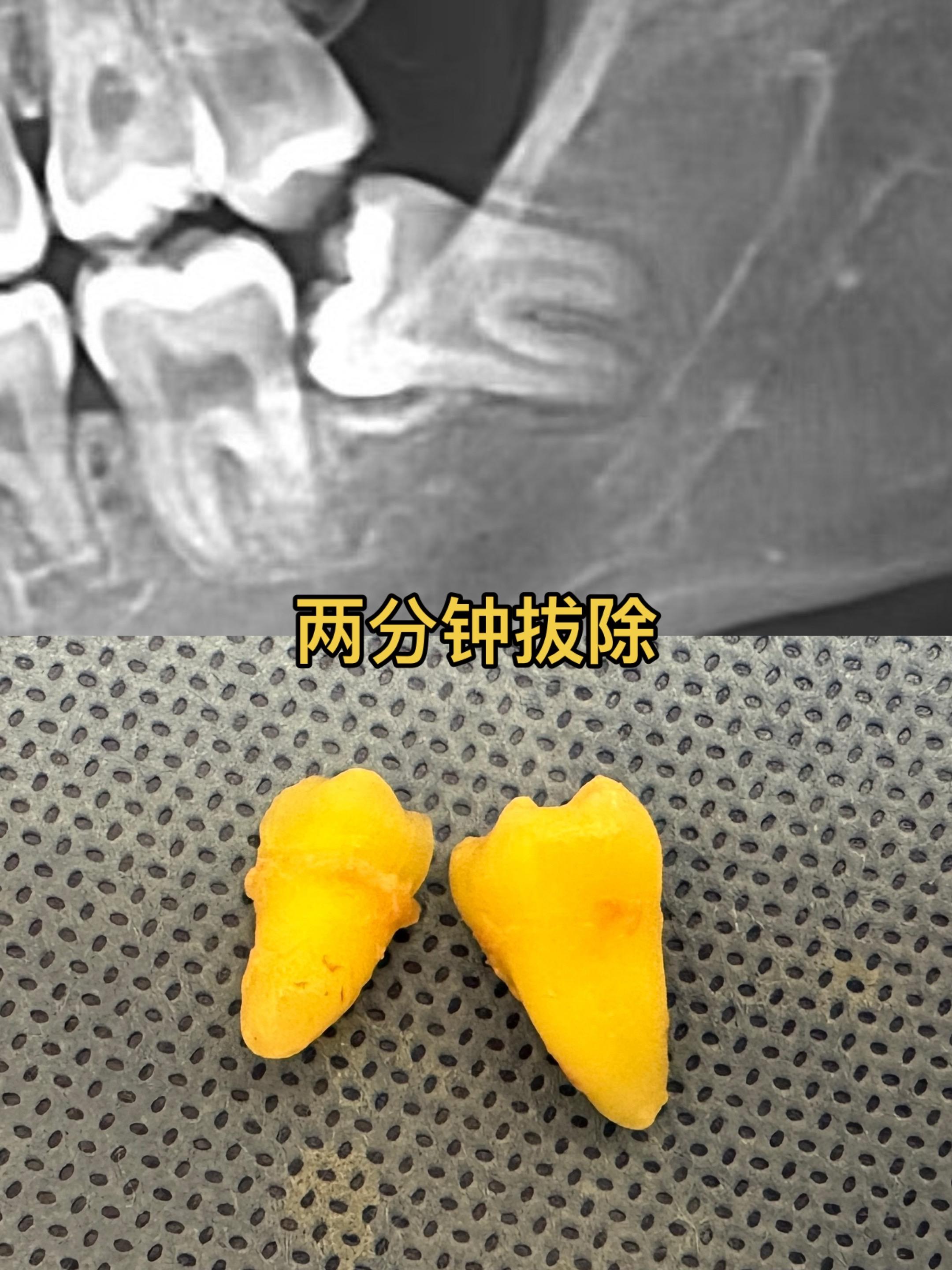 完美分割，两分钟拔除。分割的好，心情也好