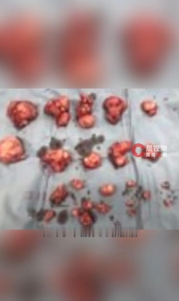 女子腹部隆起被误认怀孕6个月，手术取出50颗肌瘤，医生一句话引人深思！

近期一