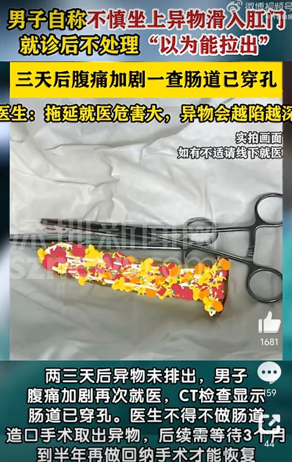 男子肛门滑入异物忍3天后肠道穿孔 这个话题充分的照顾了这位男性，据说是不慎坐入的