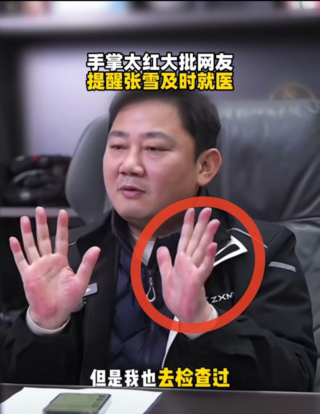 大家发现没？
张雪在直播时，他的手掌非常的红，他说这不是喝酒的，一个月不喝酒也很