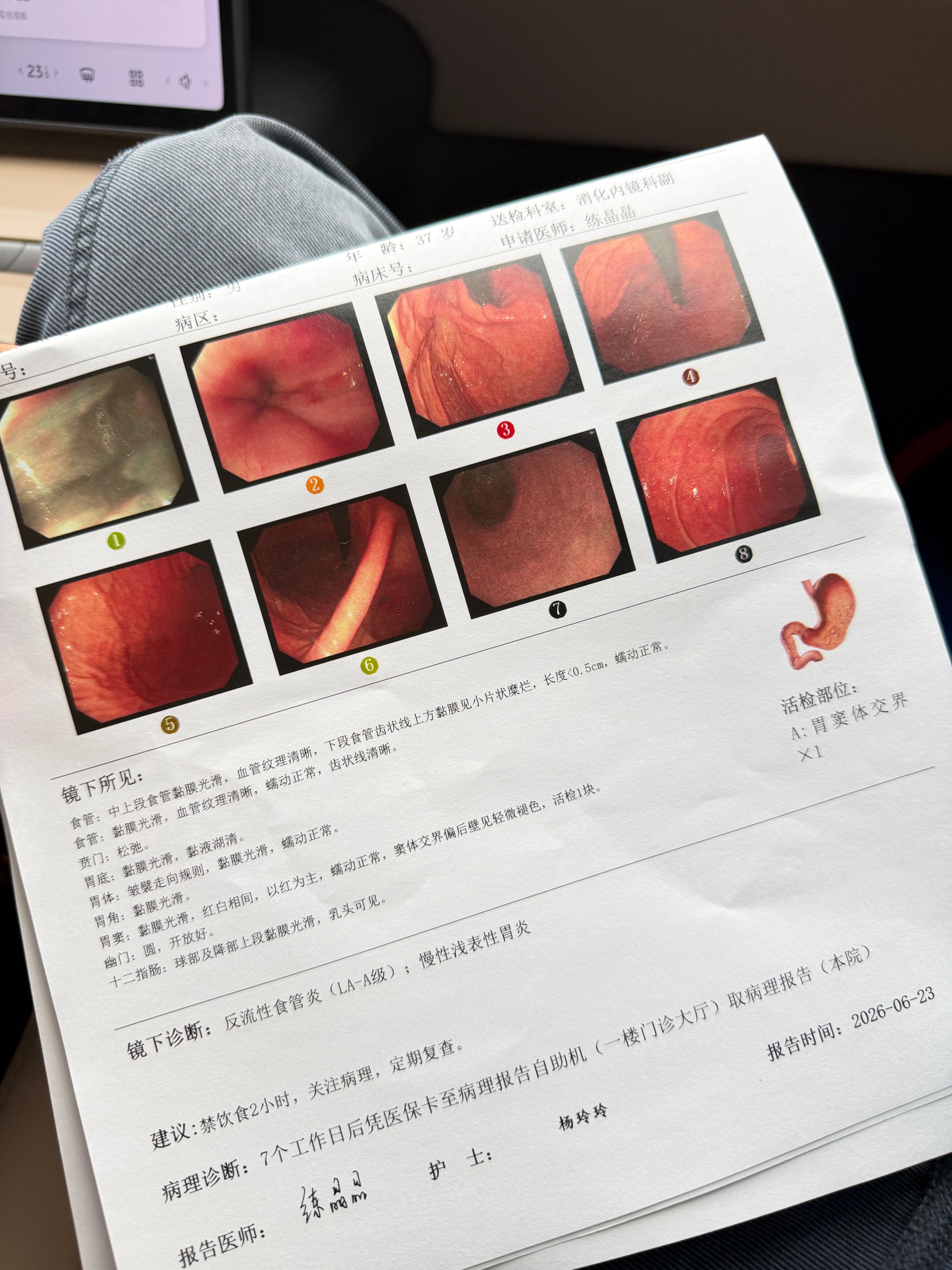 看着还行，这次居然没有息肉。前两年做还有息肉，然后直接给嘎了。不过说有个什么变色