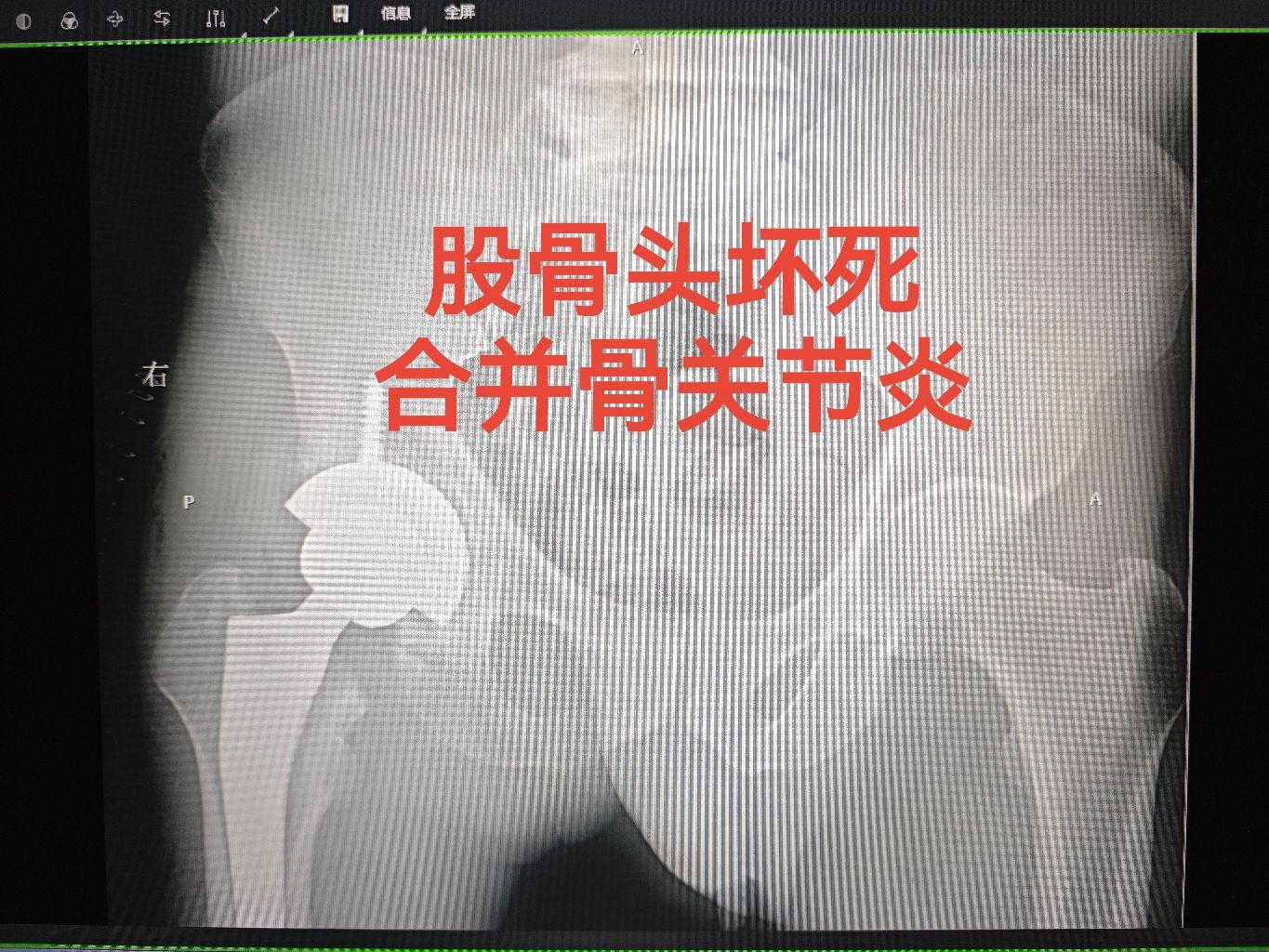 股骨头坏死。股骨头坏死合并骨关节炎15年，缩短3cm，大量骨赘形成，活...