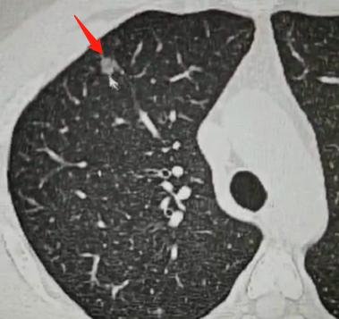 很多朋友拿到CT报告，看到“多发”两个字就很紧张，经常有人咨询我：“多发到底是有