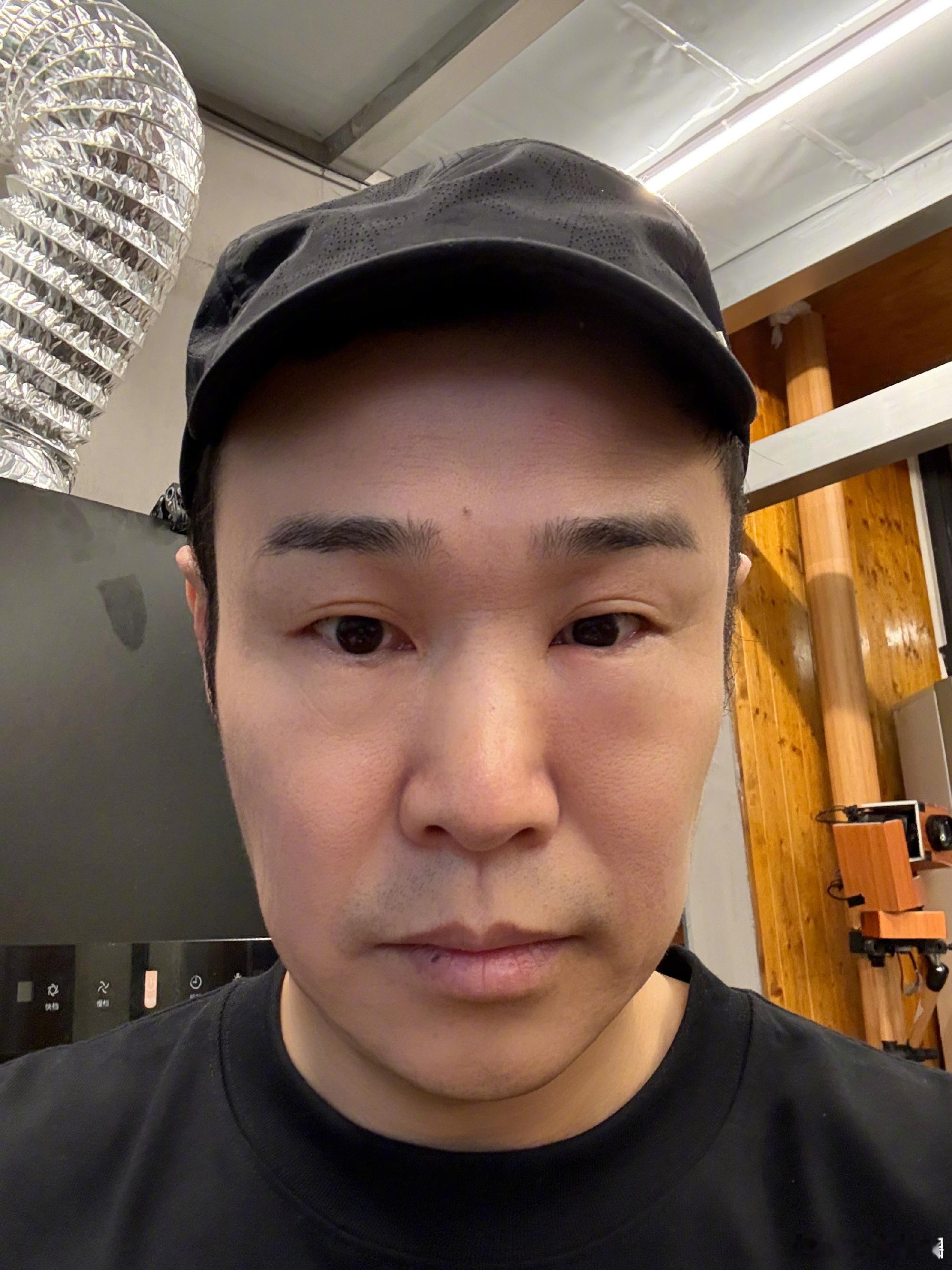 小沈阳肿成蜜蜂小狗了真的好像啊哈哈哈哈哈哈 ​​​