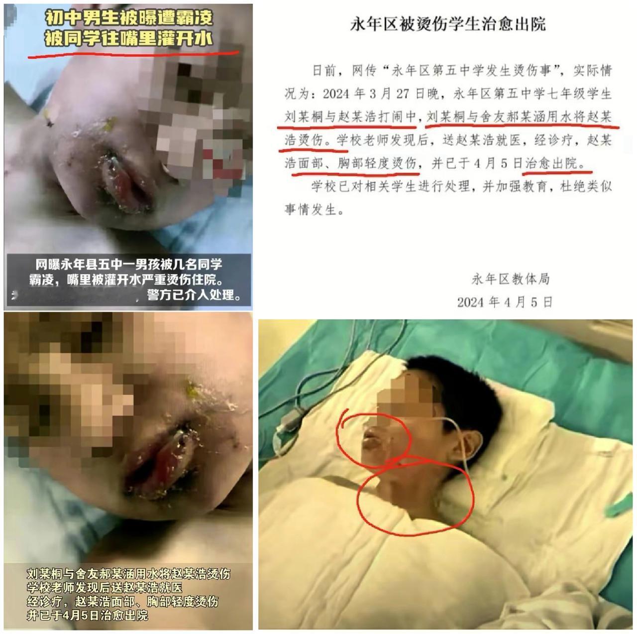 震惊！河北邯郸初中男生遭霸凌，开水灌嘴惨不忍睹！呼唤正义，修改未成年人保护法刻不