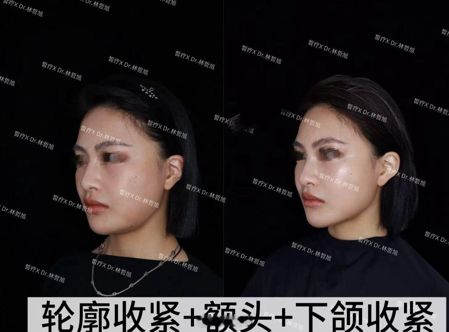 林哲旭打的芮得怡➕定采填充和超稀释收紧打法几乎解决脸上80%问题只要底子不是很差