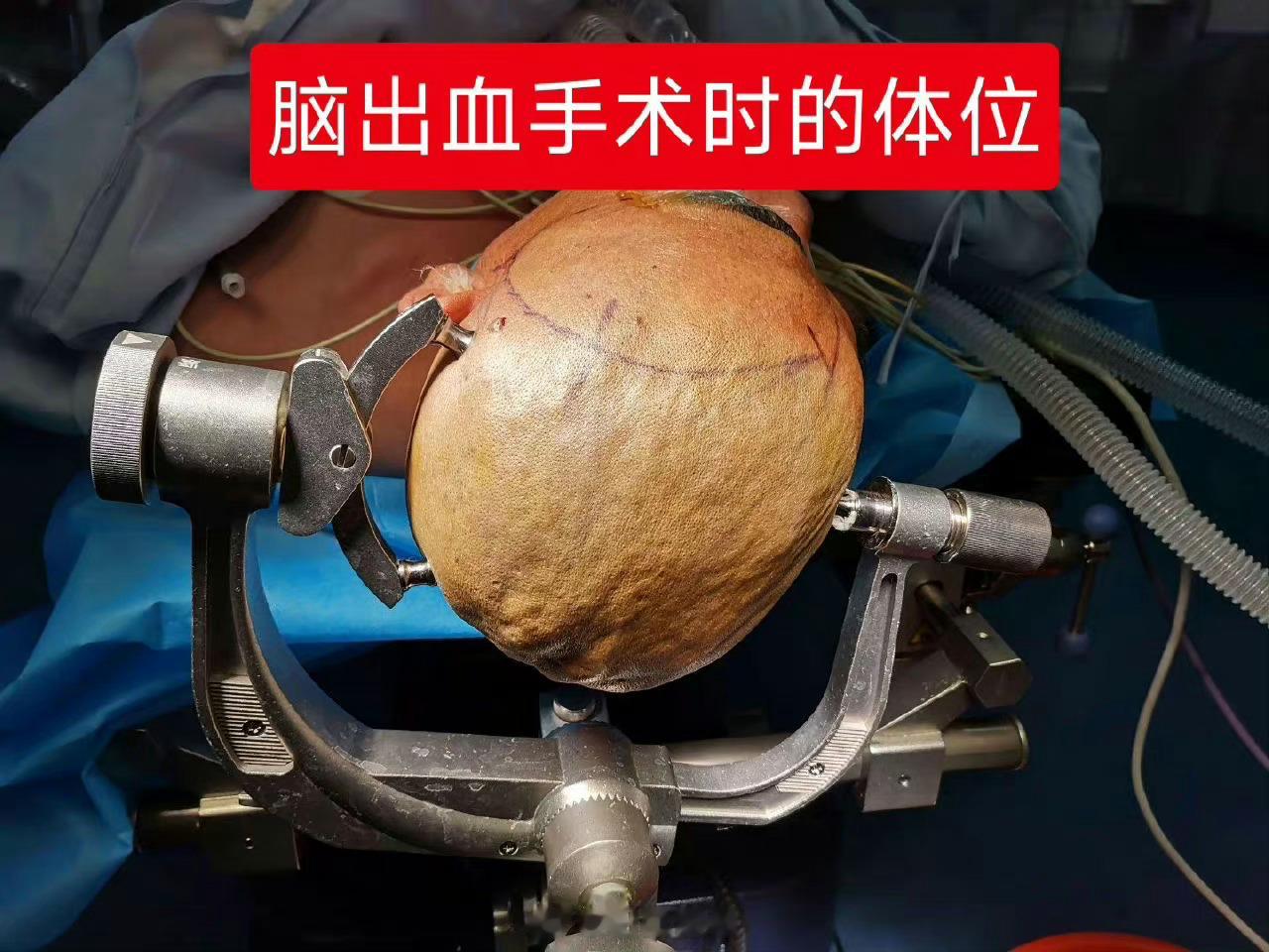 #每天一个鸡蛋可降低中分危险#发生脑卒中（中风）前，身体会发出一些预警信号❓语言