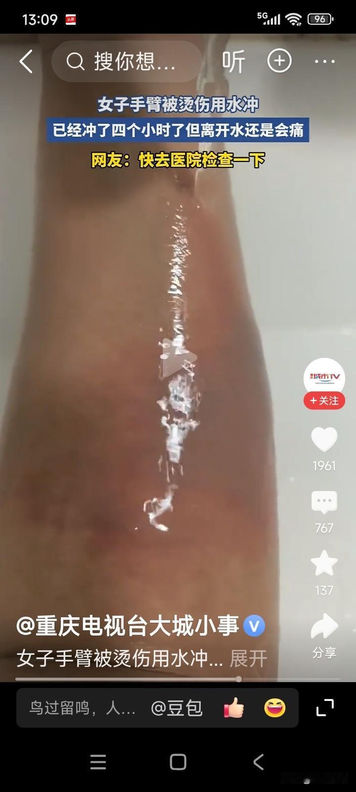一名女子不慎烫伤了手臂。此前，她曾在网上了解到，手臂被烫伤后要用凉水冲洗。
女子