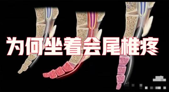 为何坐着会尾椎疼