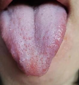 舌瘦暗红有裂纹，咳嗽总不好？这是肺肾 “水库” 干了，虚火灼肺才咳不停！
大家好