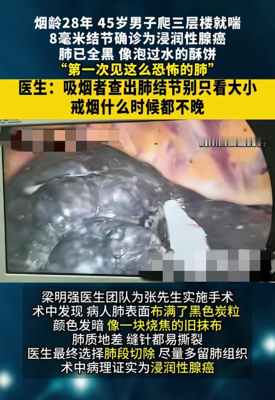 福州，一45岁男子，烟龄28年，日均吸烟一包，此前就发现爬三层楼就气喘，但并未重