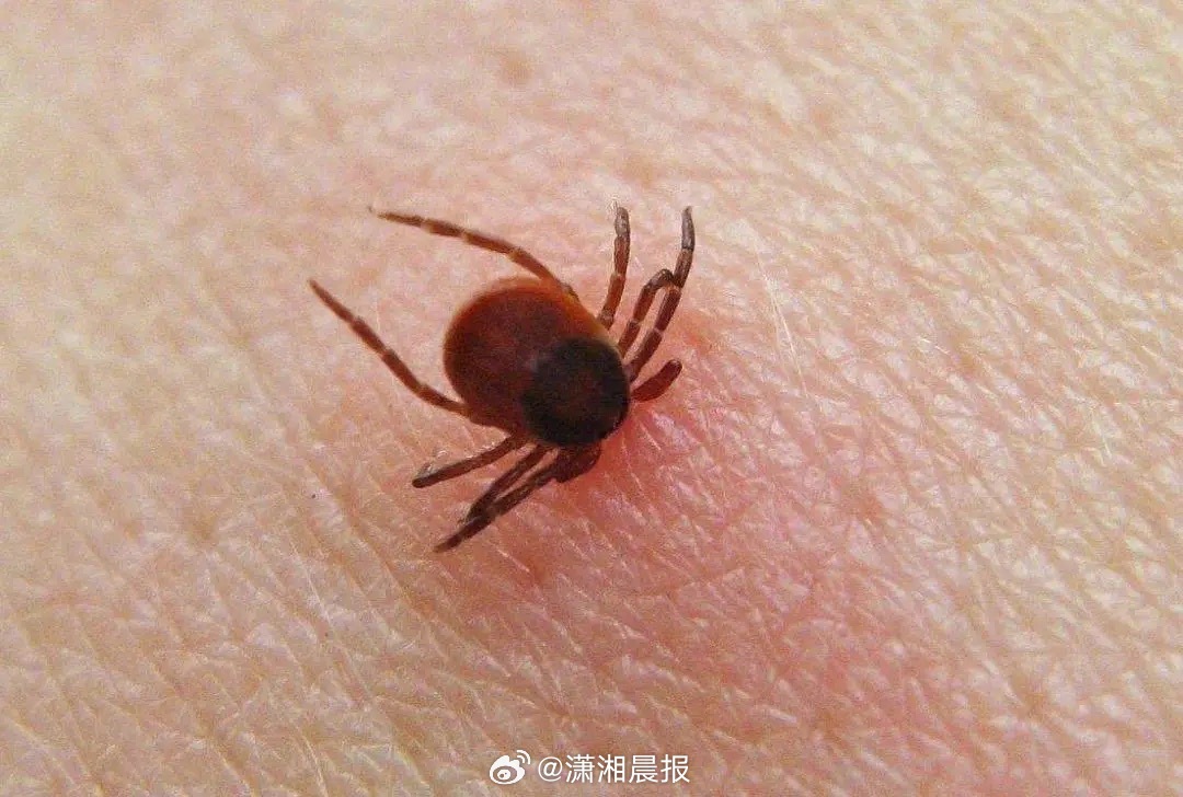 【考生及家长注意！专家谈#被毒虫咬伤后该如何正确处理#，#夏季需警惕食源性疾病#