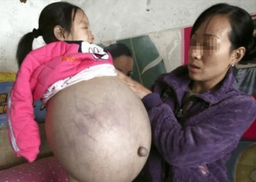 四岁半女孩腹部高高隆起，有如临产孕妇，父母焦急求医，检查结果出来后，医生一句话差