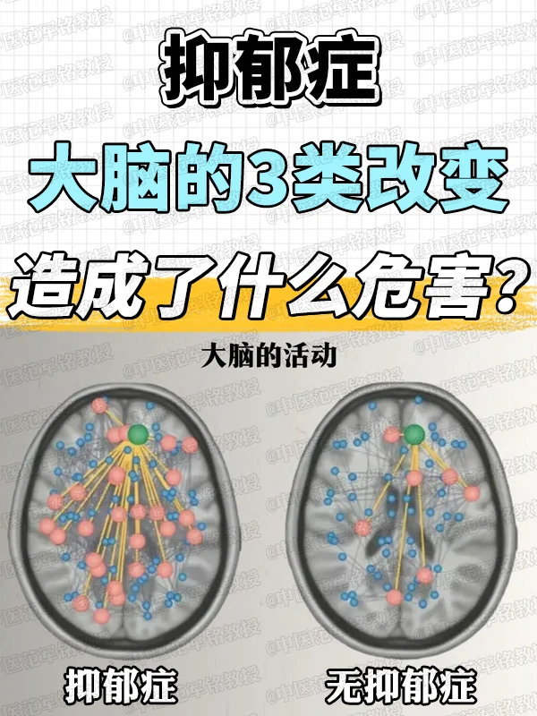 抑郁症大脑的3类改变，造成了什么危害 抑郁症是心理疾病，更是生理疾病...