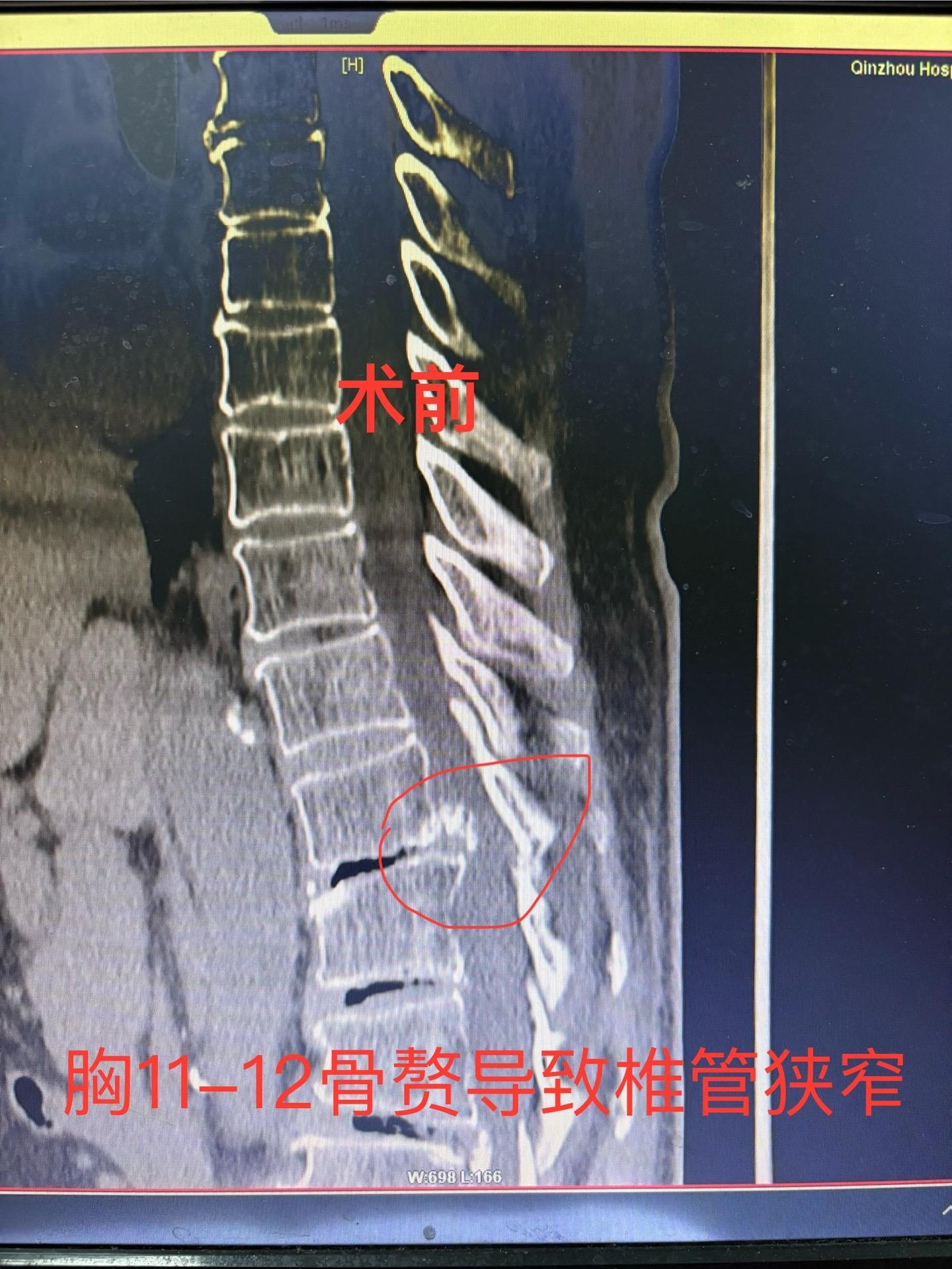 本周病例，严重的胸椎管骨性狭窄，脊髓明显压迫，行走不稳，高龄基础疾病多...