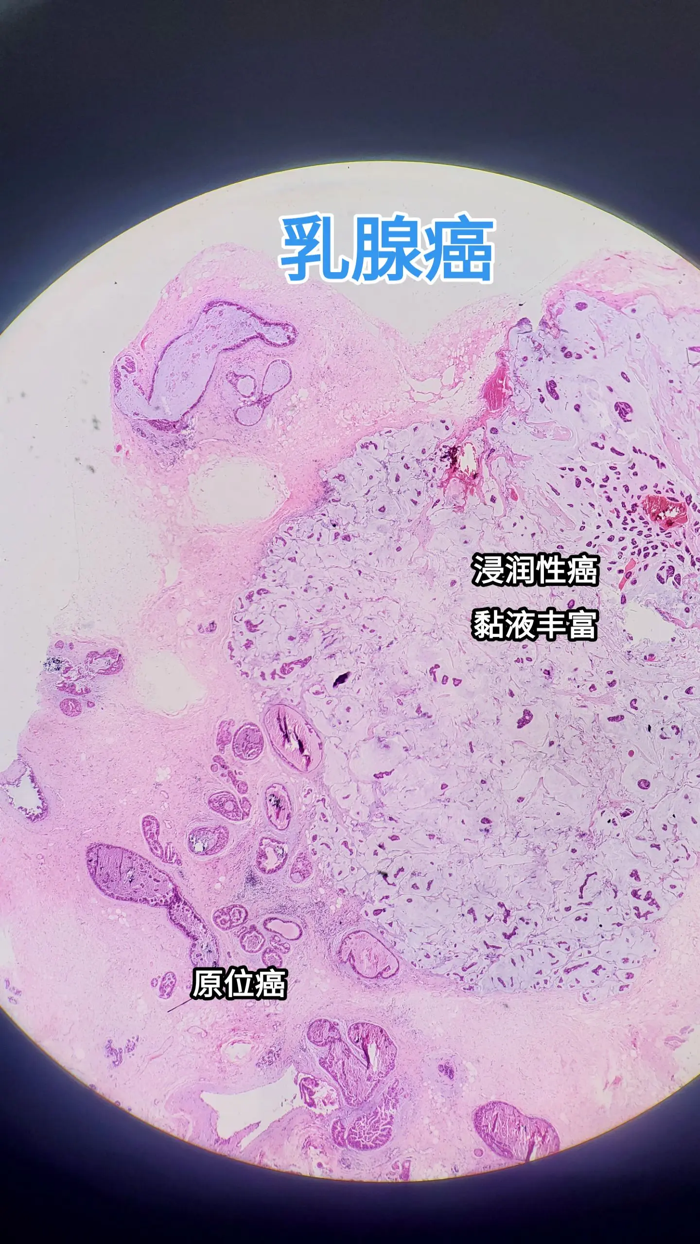 乳腺癌