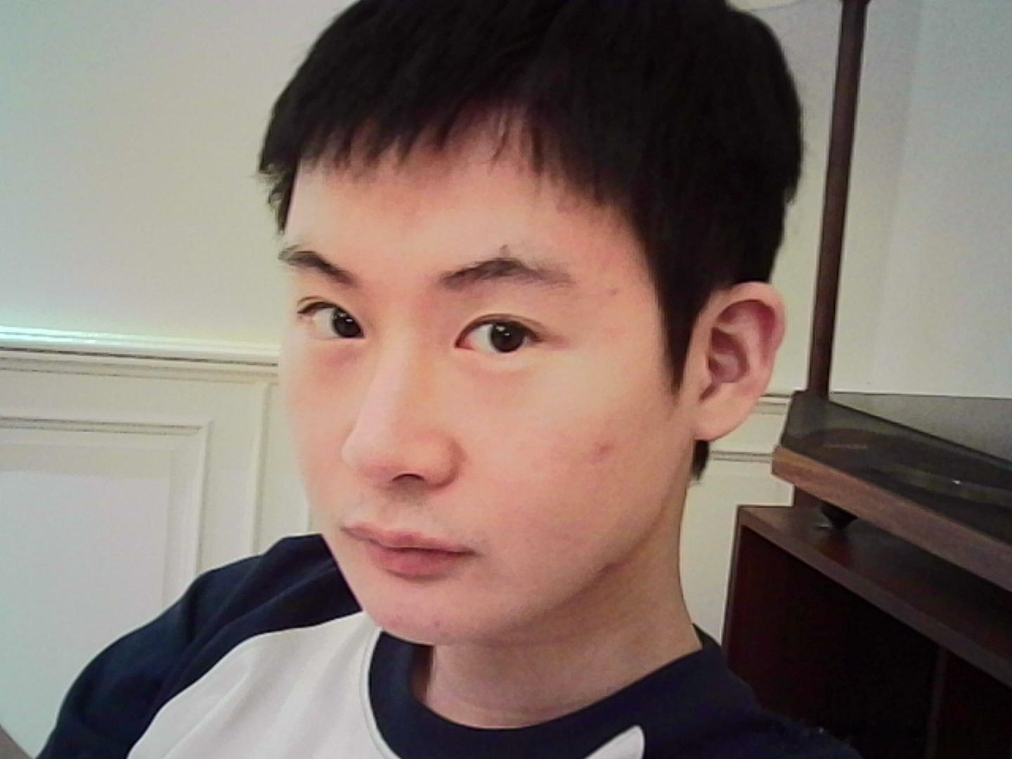 深覆合真的好丑啊，我明天要把唇珠剩下的一点点玻尿酸给溶解了，然后在口内进针做颏唇