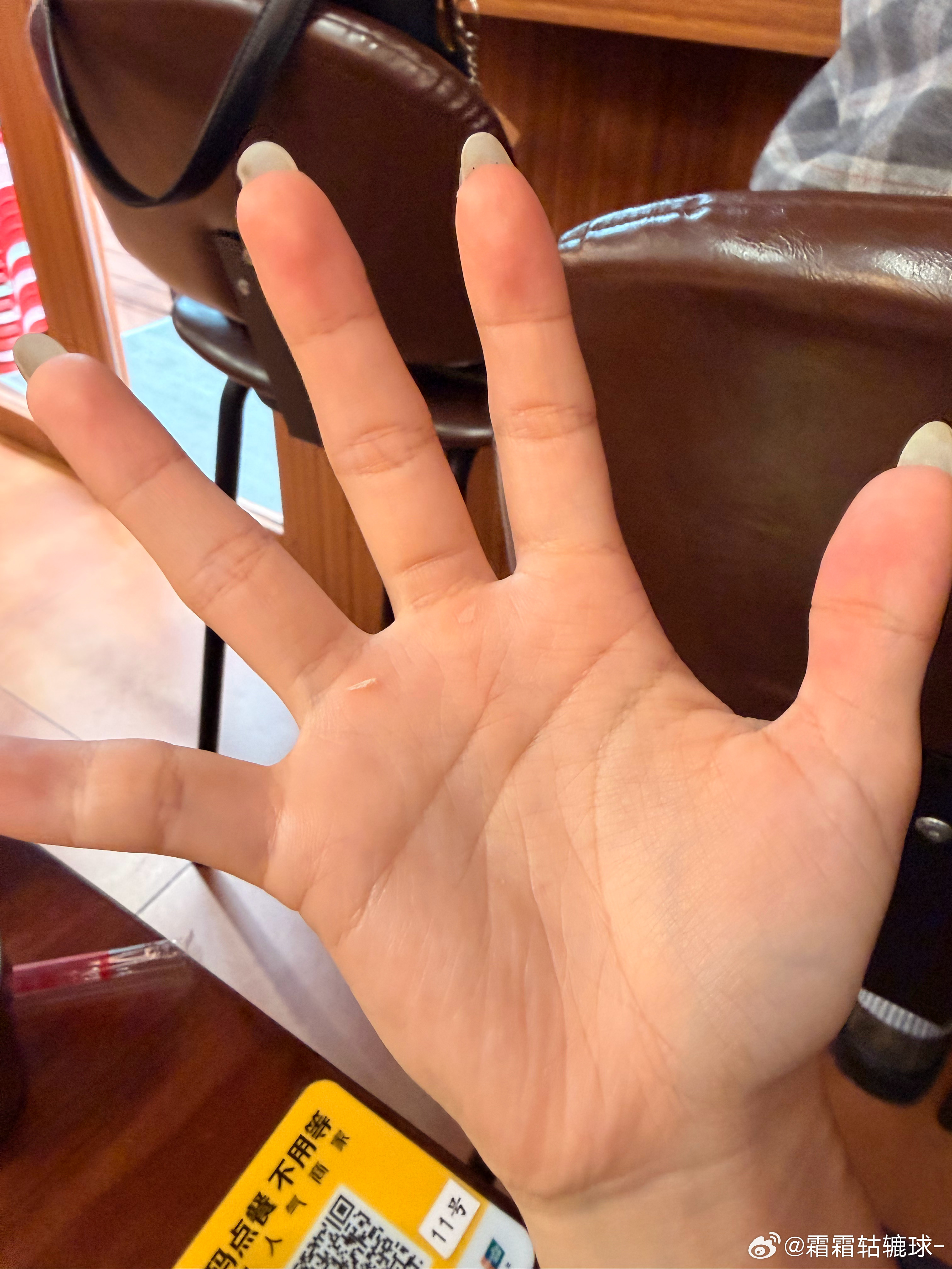 本人有氧转无氧ing，练出的茧居然脱皮了！确诊了细菌性结膜炎，但不造为啥明明是眼
