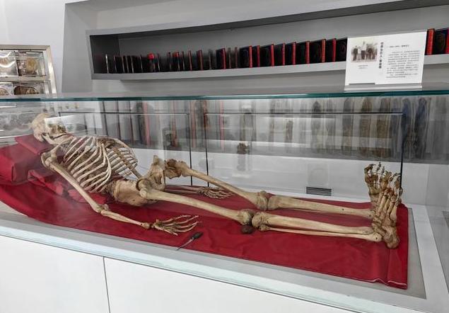 2005年，湖南湘雅医学院的标本室里，放着中国“第一女巨人”曾金莲的遗体，白布包