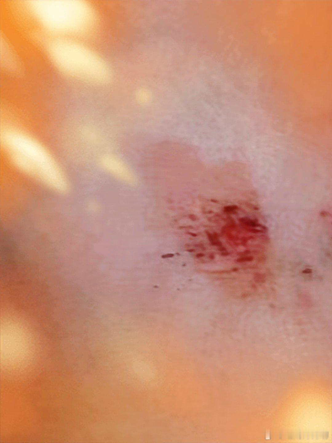 前两天晚上做梦被狗追，然后咬伤了脚，这几天一直在想解这个梦！好了，现在梦已经变为