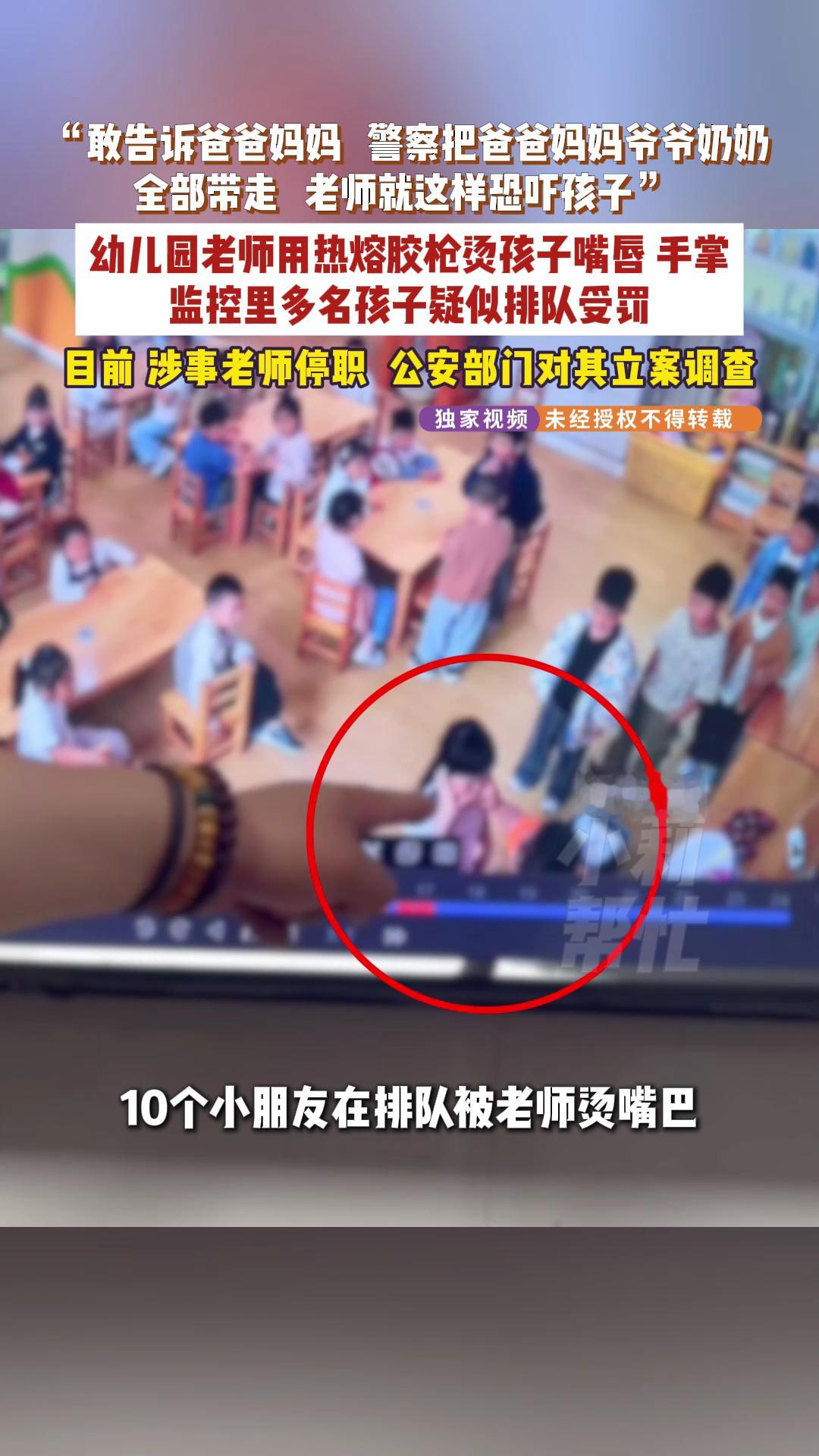 孩子嘴巴被幼儿园老师用热熔胶烫感染多名幼儿园小朋友被老师用热熔胶烫伤必须加强对幼