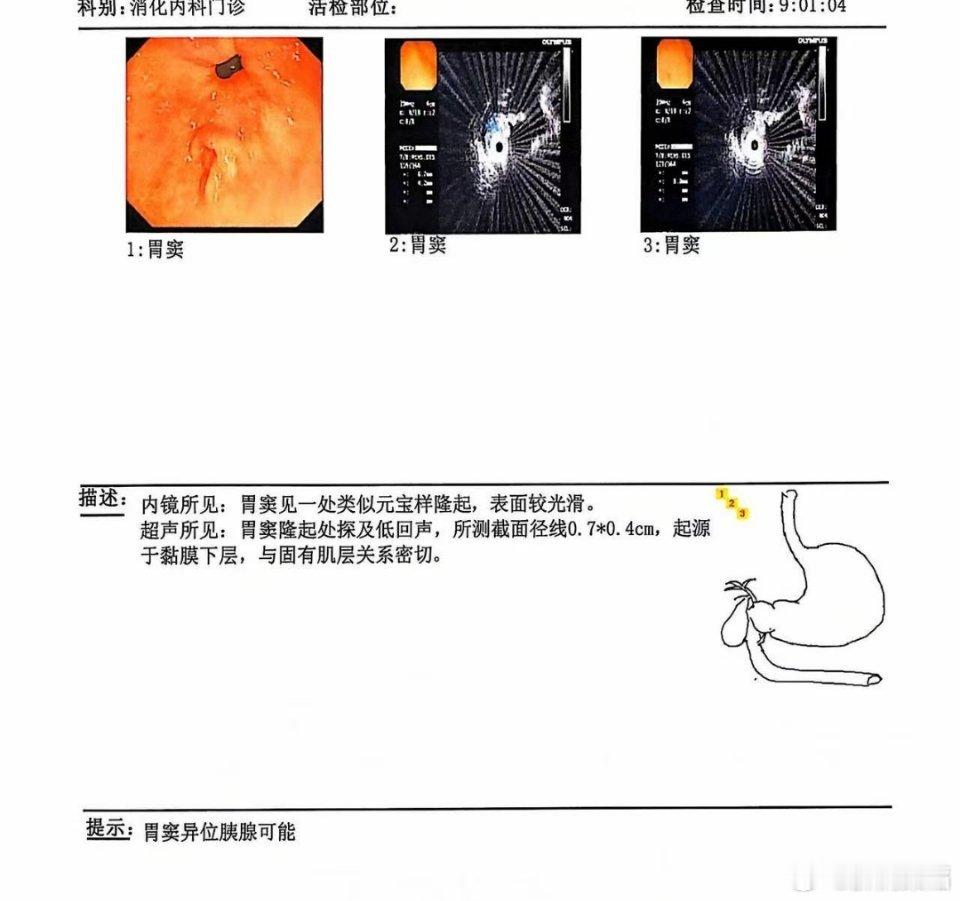 异位胰腺的原因和处理： 异位胰腺的形成主要是胚胎发育异常导致的。在胚胎发育过程中