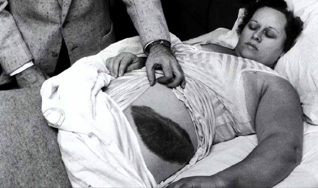 1954年，一女子正在睡觉中，猛然感觉腹部和大腿被什么东西蹭着了，疼痛难忍，等她