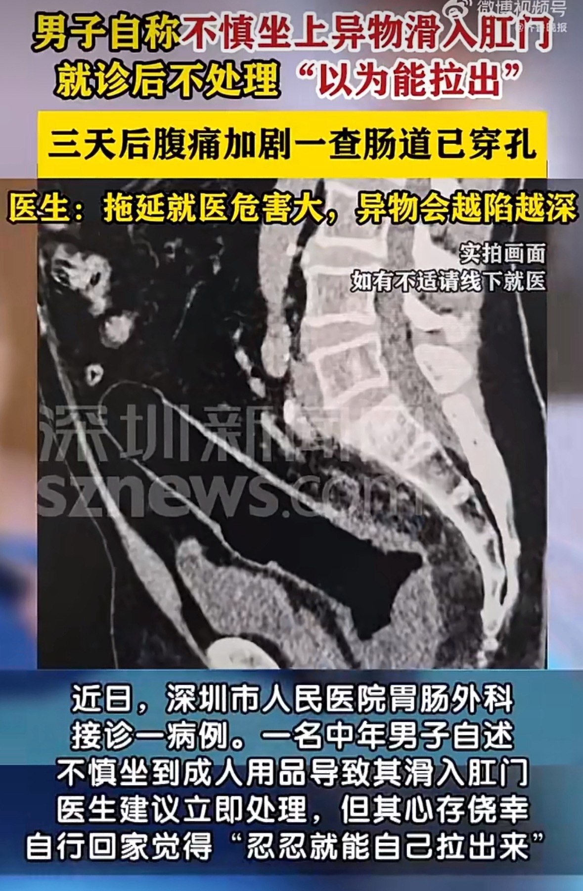男子肛门滑入异物忍3天后肠道穿孔啊