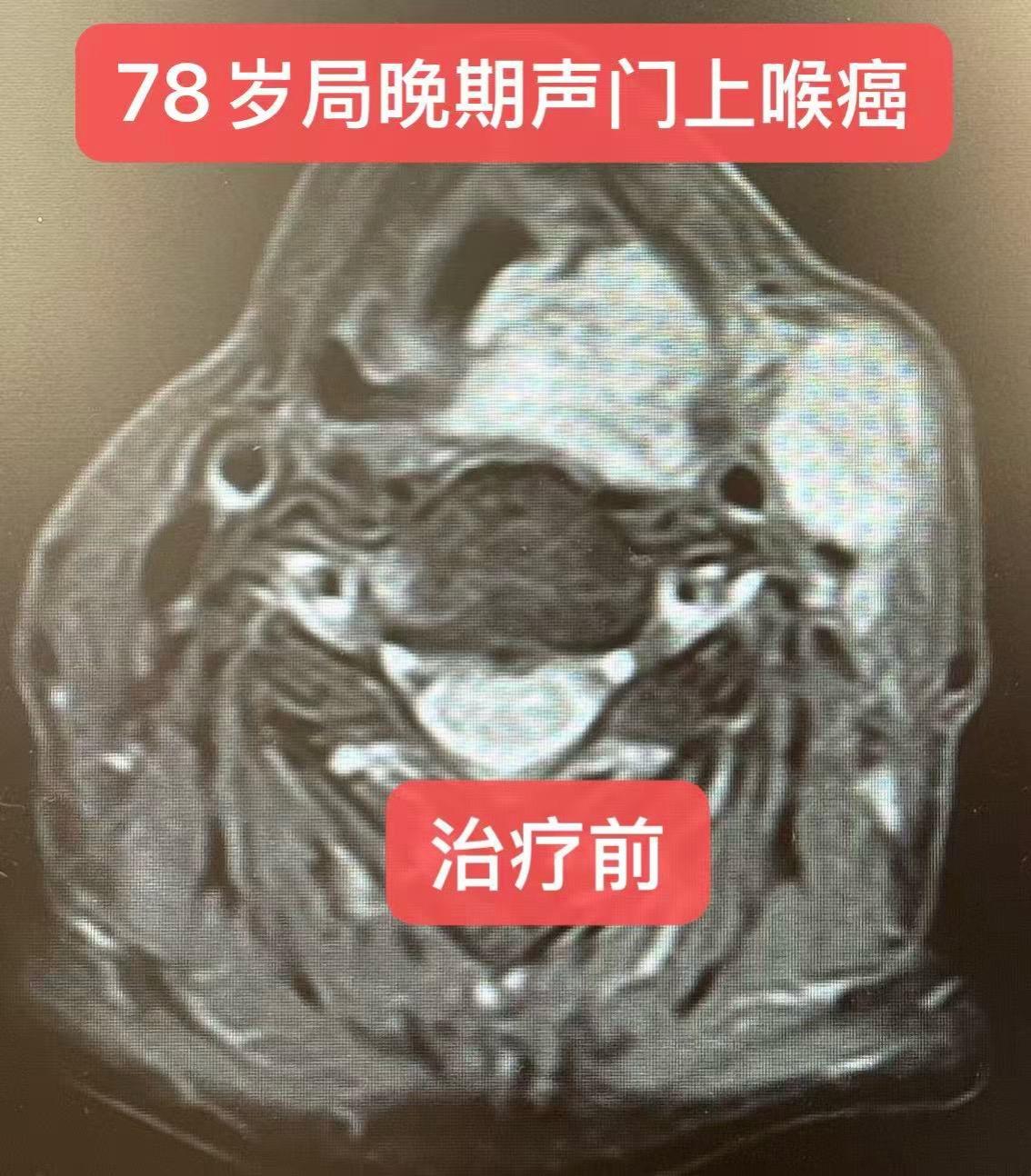 78岁，晚期喉癌的治疗。患者男，78岁，从深圳来，声门上喉癌T4aN2...