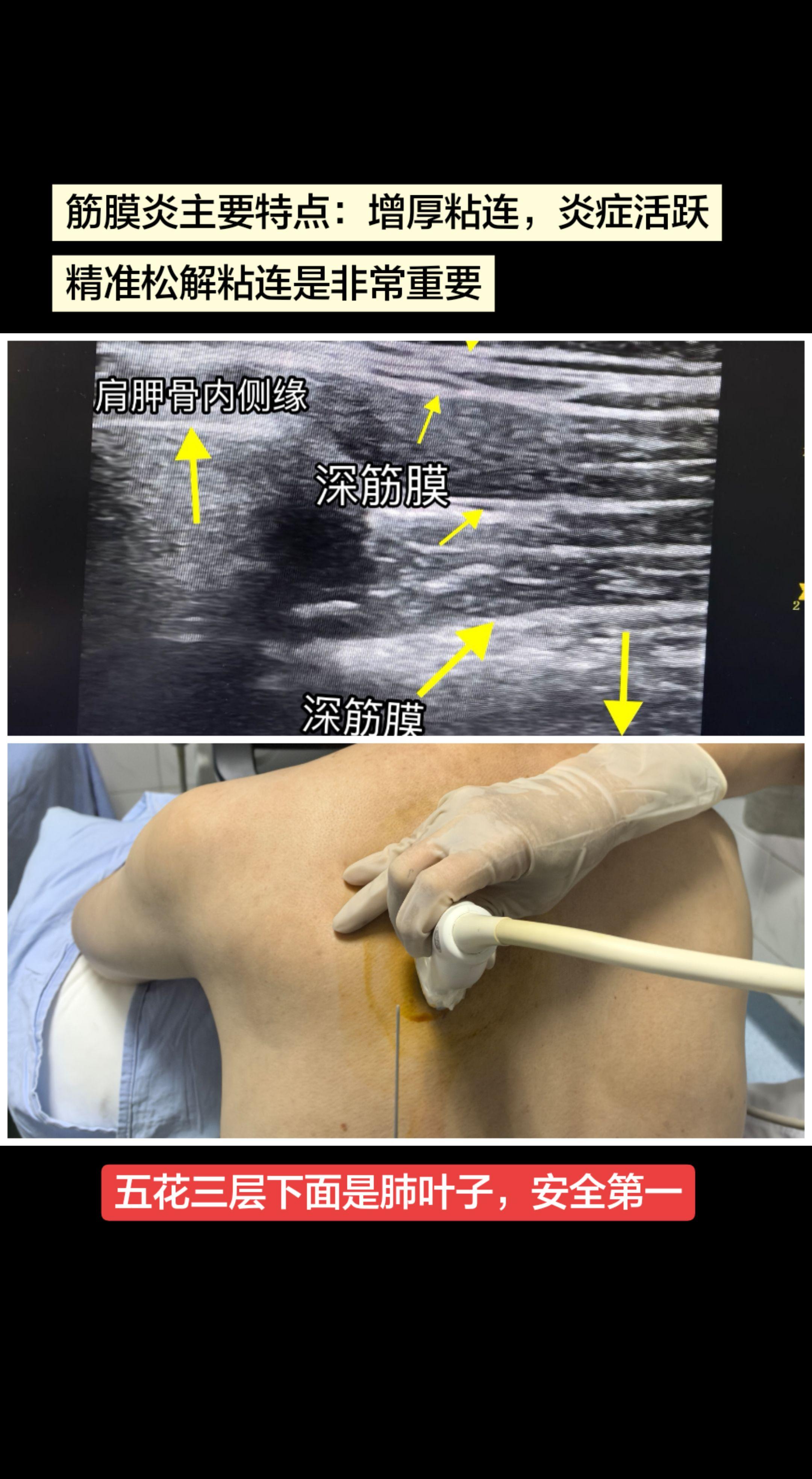 超声可视化实现了传统与现代、精准与安全的有机统一，同时坚持在指导下锻炼...