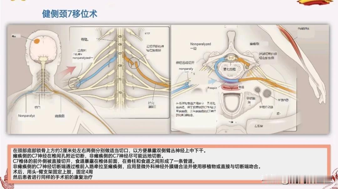 #脑出血偏瘫多久能恢复?#
脑出血之后，根据脑出血的部位、脑出血量的大小和对神经