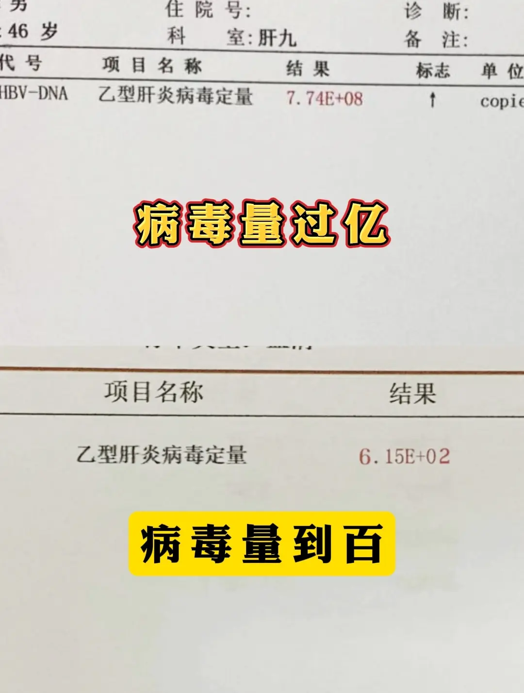 乙肝病毒量从7亿多到600多，我见证了这位山东乙肝大三阳患者的一路治疗...