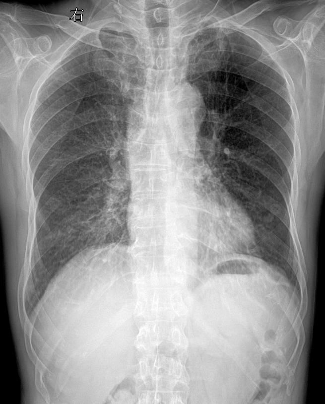 又来一张，患者主诉:胸闷，咳痰