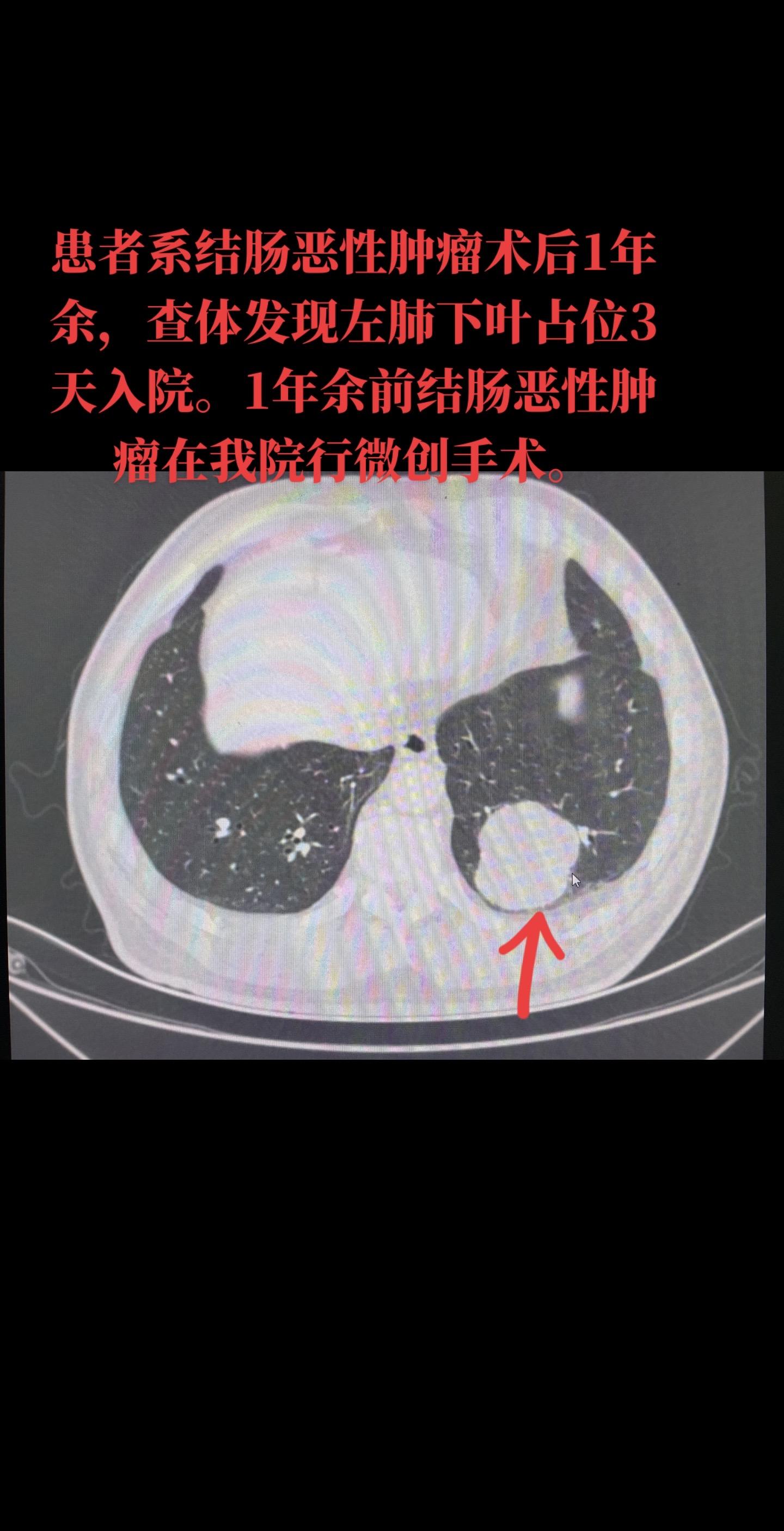 病例分享：左肺下叶中分化腺癌伴坏死，符合结肠癌转移。建议患者积极行化学药物治疗，按照结肠癌的化疗方案进行治疗，定期检测患者各项指标，及时发现它处转移可能。