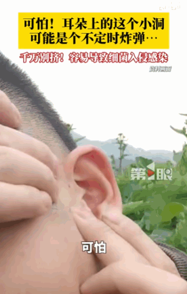 真是祸从手出！家长千万别再乱挤了，孩子耳前一个不起眼的小洞，本是民间所说的“耳仓