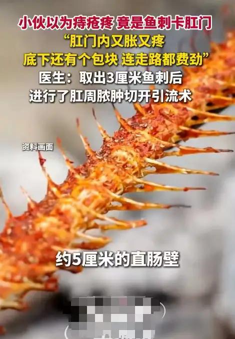 震惊！一根鱼刺，竟让男子差点“翻车”！

事情还得从广东的徐先生说起，本以为只是