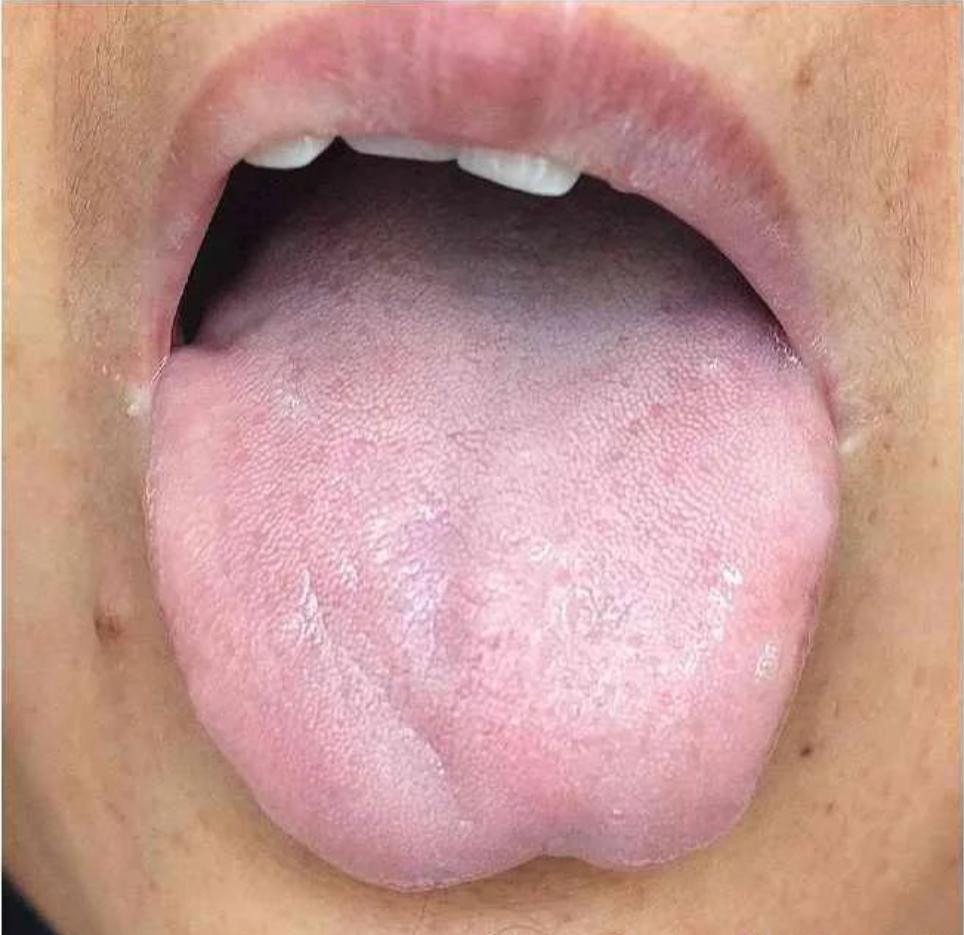 起立总是不够硬，中途就变软，中医辨证：脾虚是关键！

前段时间来自陕西的李先生来