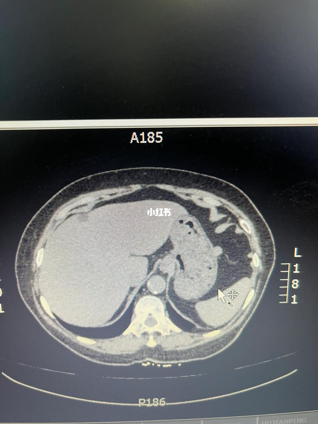 抓到一个可爱的小瘤子