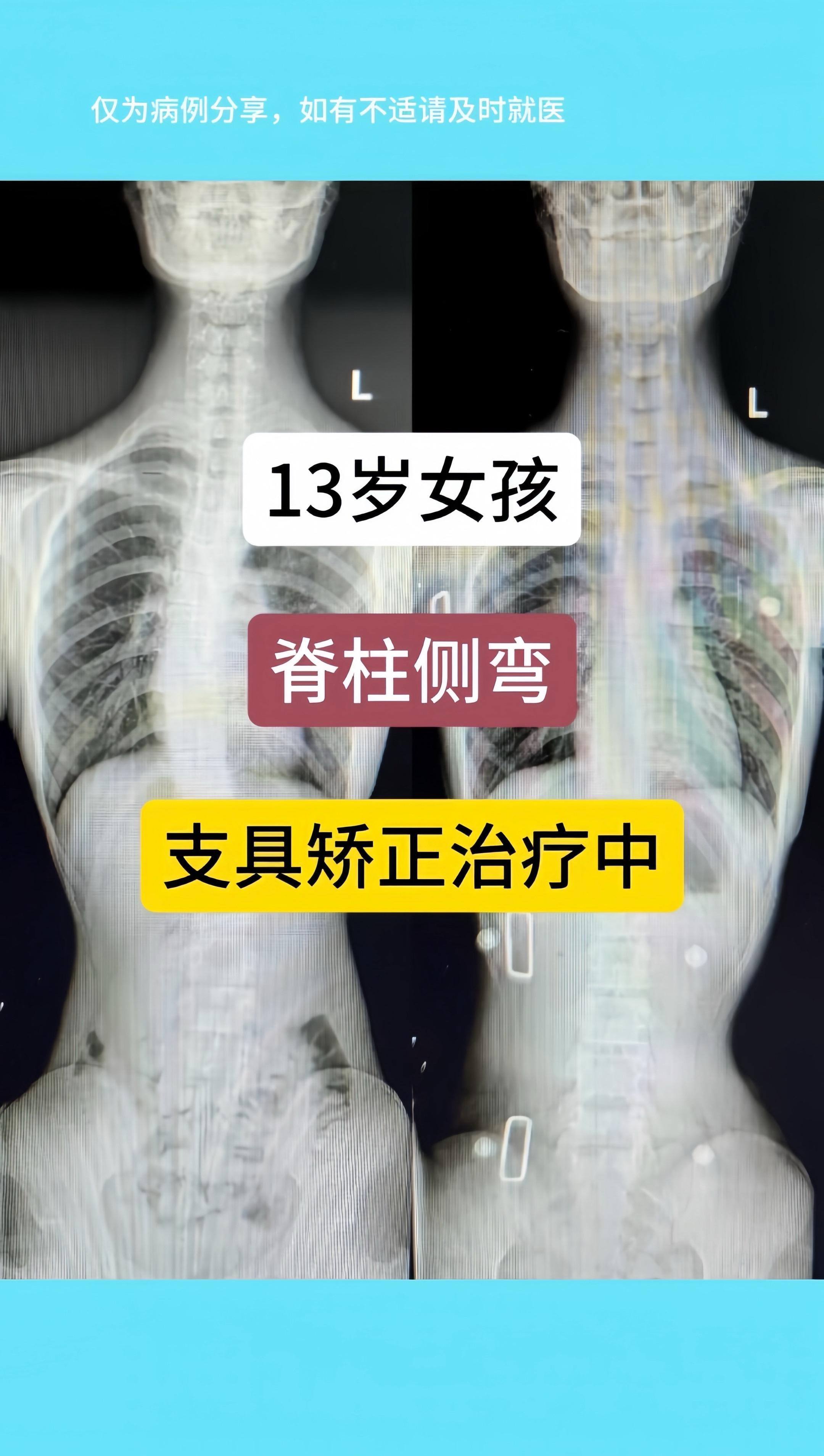 13岁女孩，脊柱侧弯，支具矫正治疗中。矫正效果好。