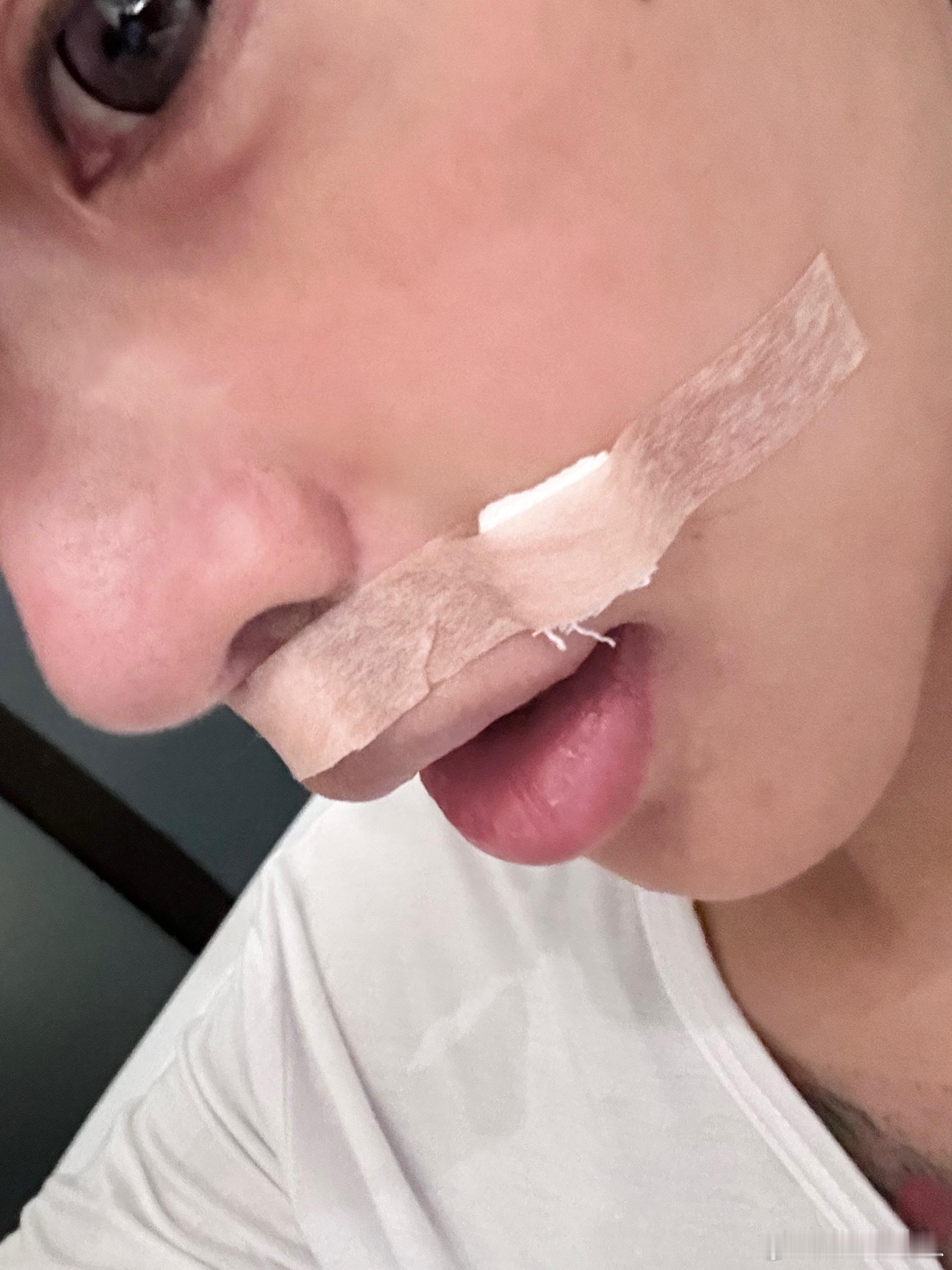去把两颗肉痣切了以后修图少个步骤 ​​​