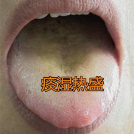 常见虚不受补的三种舌象，都给你总结好了，以后就知道怎么应对了
 
 
1、舌前红