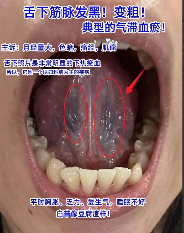 今日舌诊案例分析：湿热下注，心肝火旺，气滞血瘀，脾肾阳虚[谢谢][谢谢][谢谢]