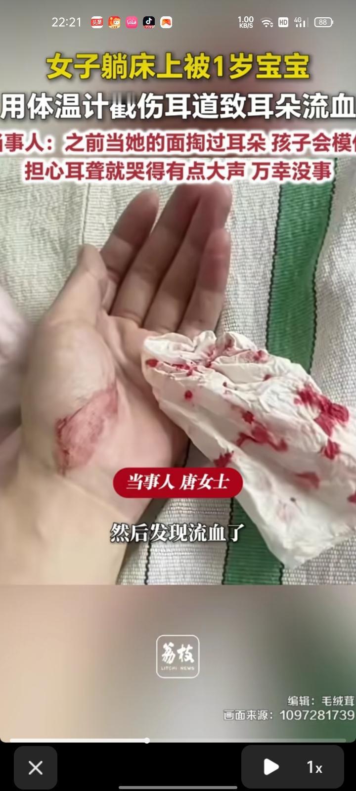 8月6日，山东济南。网友发视频称，自己躺在床上刷手机，被宝宝拿体温计戳伤耳道致耳