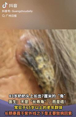 活久见！浙江义乌，一八旬老太因经常晒太阳，结果太阳穴上长了个黄豆般的凸起物，又因