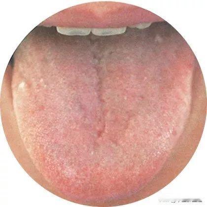 肝郁火旺，脾肾阳虚，不能只疏肝，泻火才是关键！！教你一招搞定！
患者主诉：情绪急