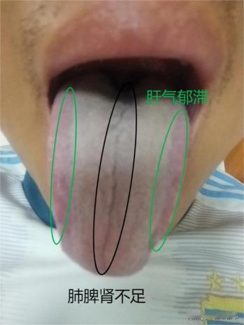 这种舌头，舌中有裂纹，你要是光当脾虚治，药吃一箩筐效果也不会好！
这个病人说啊，