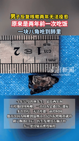 “活久见！”浙江温州，一52岁男子两年内持续咳嗽，起初还以为是感冒后遗症，可多次